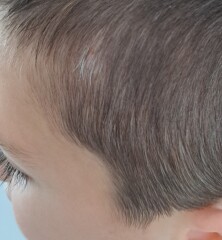 6yo grey hair and mole on scalp -should I be worried 