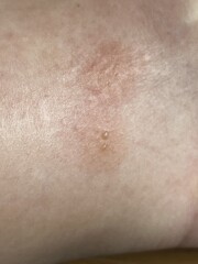 Do we have bedbugs or just fleas?