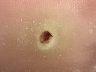 What the hell is this hole in my foot?