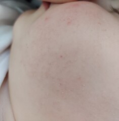 Rash on Cheek & Arms 