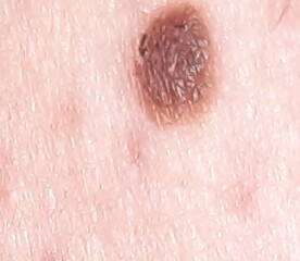Scared - skin cancer