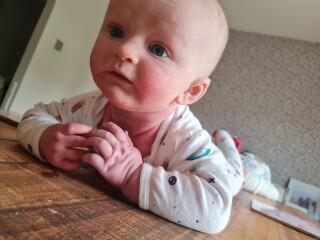 Baby's Skin is Red Raw