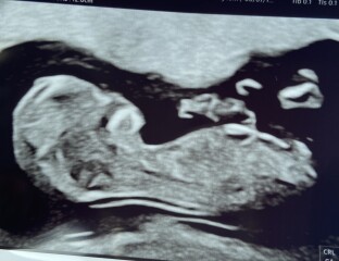 Boy or girl? No visible nub 