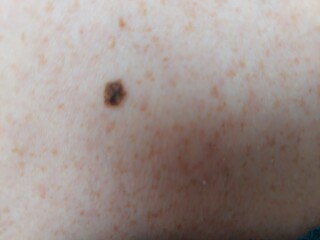 Mole