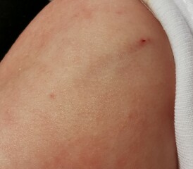 Vaccine holes