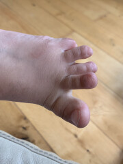 Is this an abnormal set up of toes (pic included)?