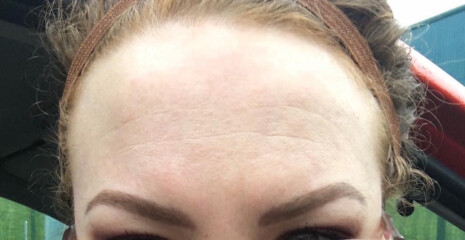 Has anyone managed to reduce wrinkles without Botox or filler?