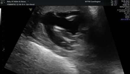 Gender guesses/nub theory? 