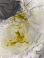 Sudden change in baby poo - jelly like green poo
