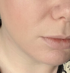 Has anyone managed to reduce wrinkles without Botox or filler?