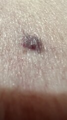 On a scale of 1-10, how worried would you be about this mole? Pic included. 