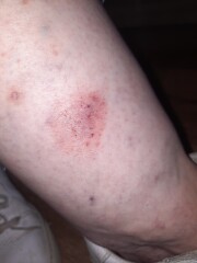 Scared - skin cancer