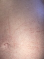 Red marks on stomach