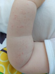 Rash on Cheek & Arms 