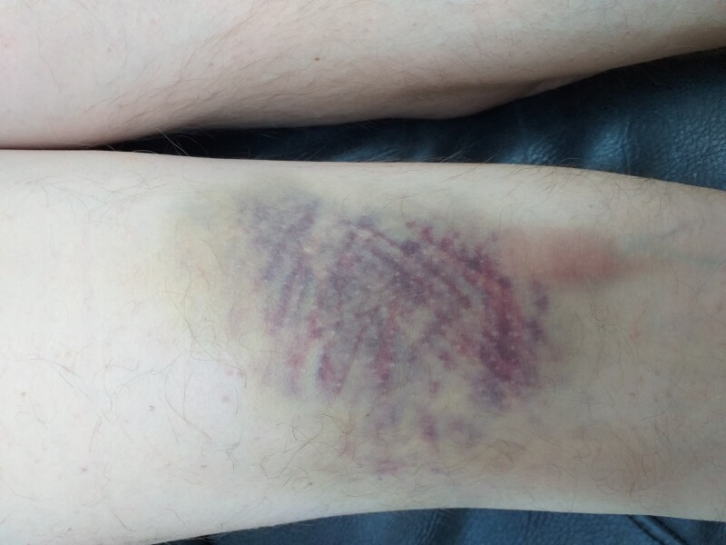Internal injury to back of knee/thigh