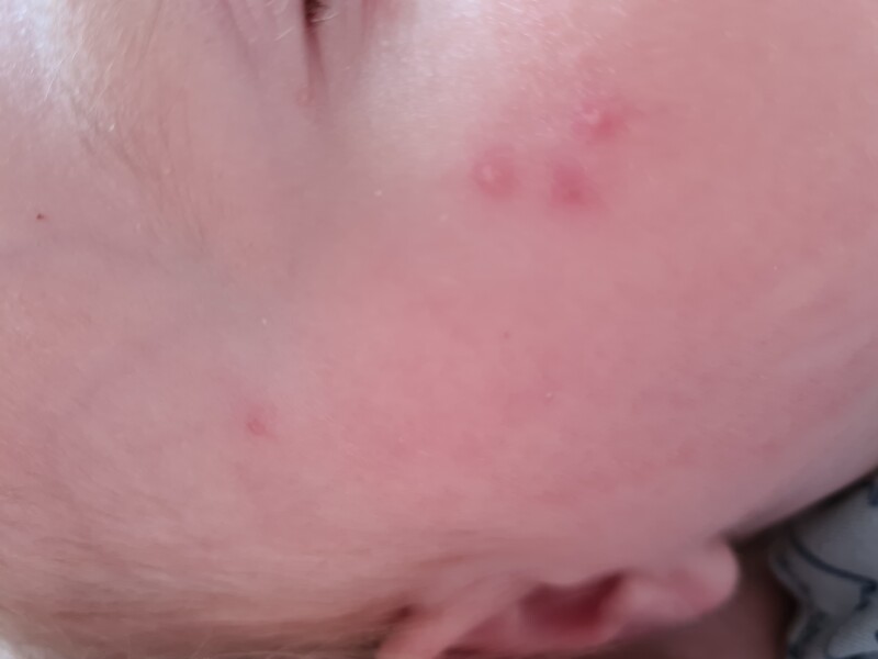 Bedbugs bites?? Please help!
