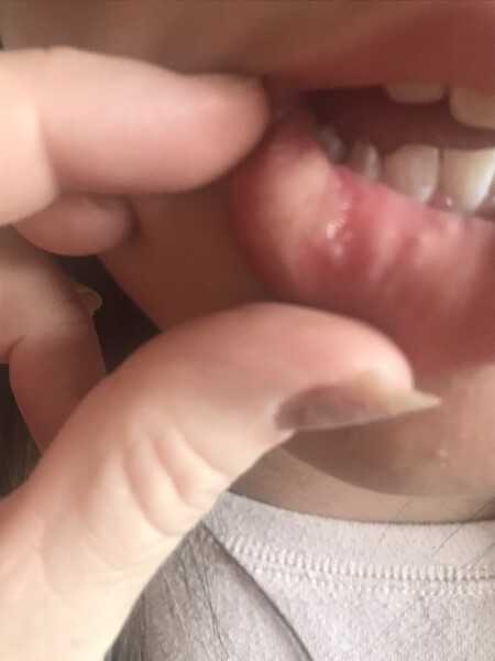 Ulcers