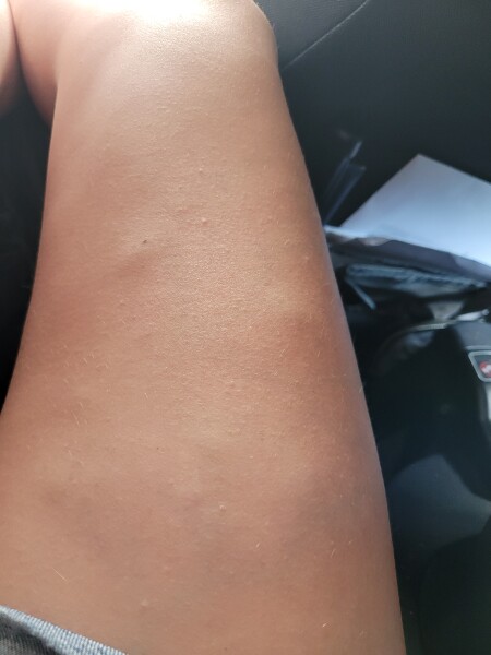What is this on my legs?