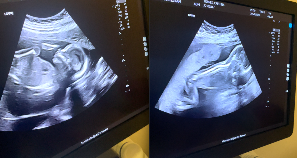 BFPs after IVF - navigating pregnancy - pt 2!