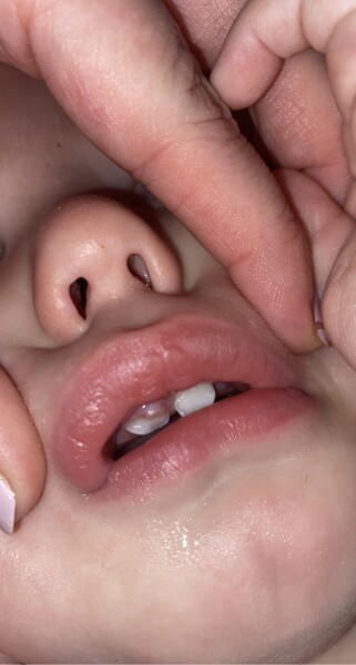 My toddlers tooth looks odd and I’m a bit worried