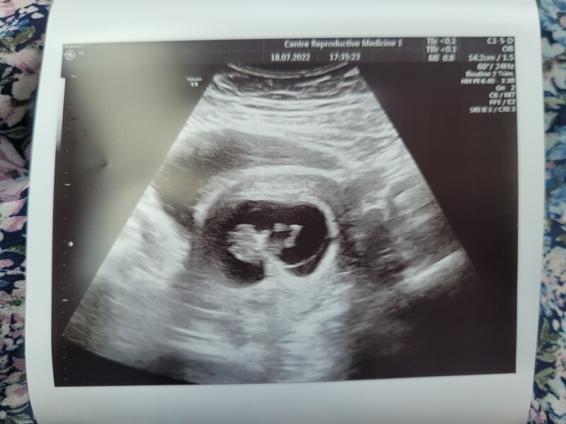 Pregnancy after miscarriage - thread 2