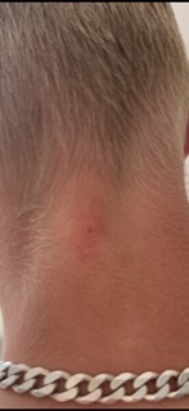 Monkey pox or mosquito bites?!