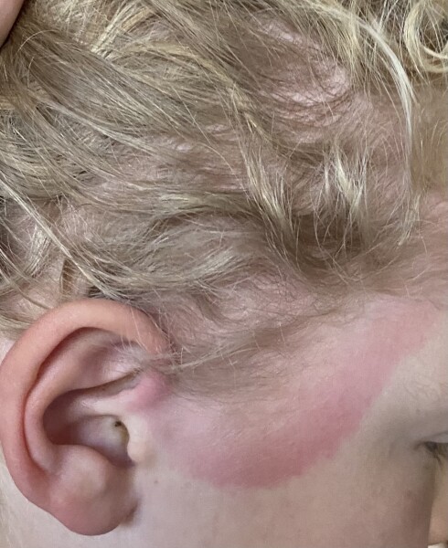 Lyme disease symptoms 