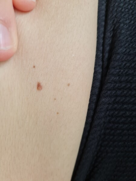 Abnormal mole