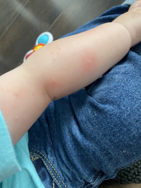 Raised bumps all over my sons arms and legs
