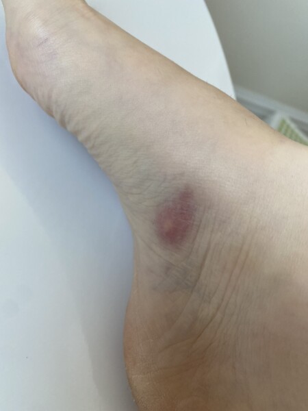 Insect bite worry