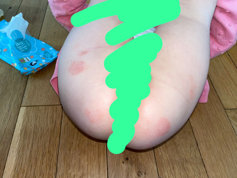 Can anyone help me identify my 2 year olds rash?