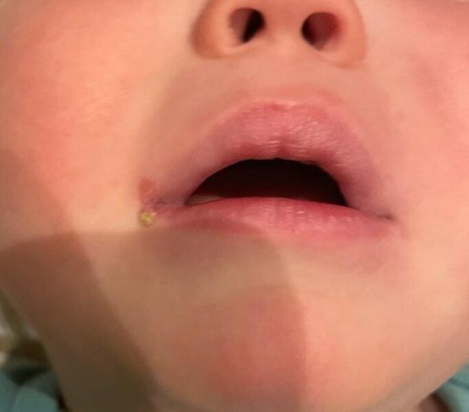 Baby cold sore, impetigo...?