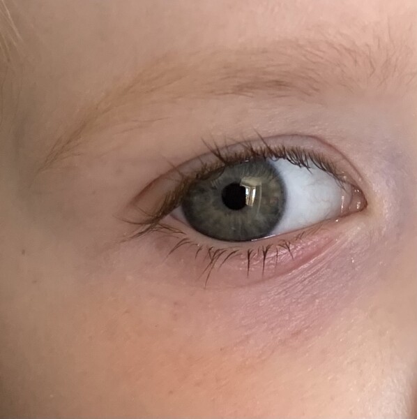 What’s up with DD’s eye? 