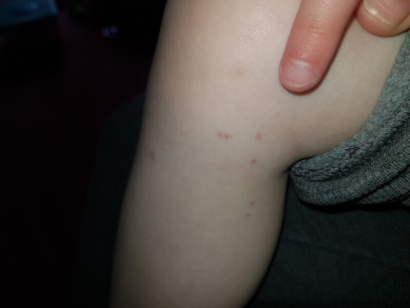 Does this look like chickenpox?