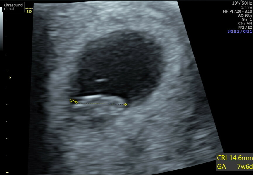 8 weeks on Monday and booked a scan