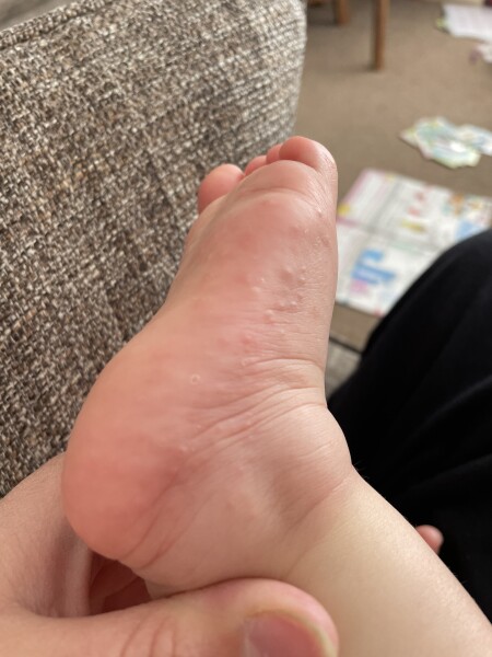 Eczema spots on baby’s feet?