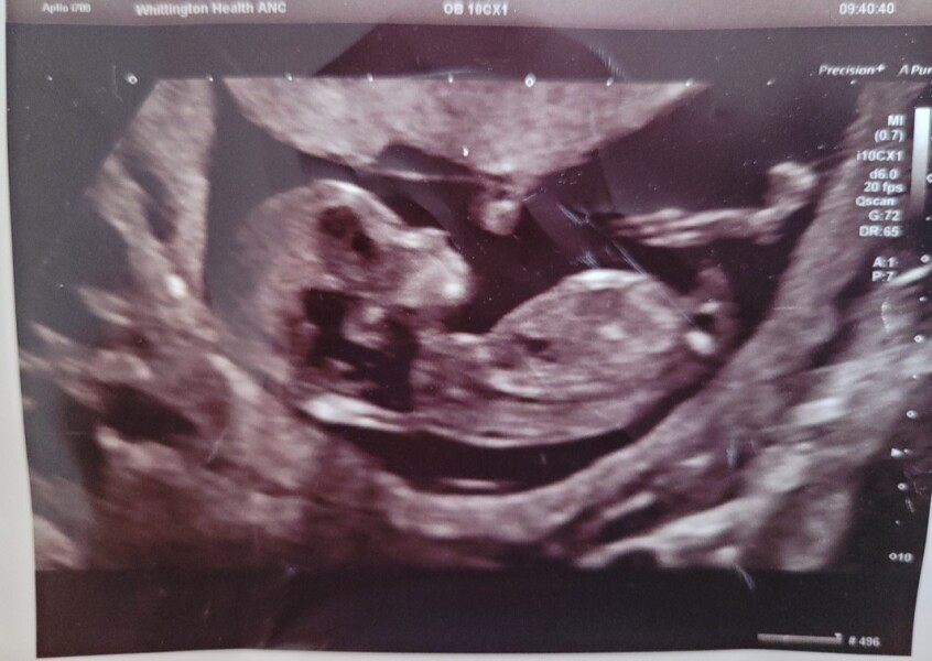 Can anyone guess the gender 12+6 days 