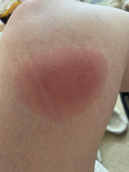 Watch out for TICKS