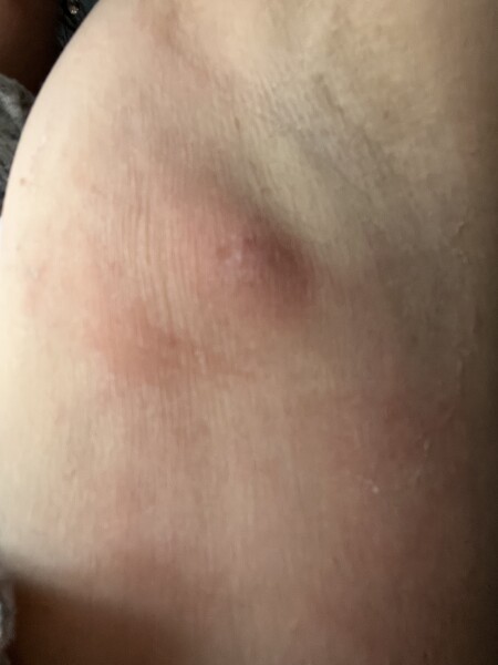 Is this a boil?! Help! 