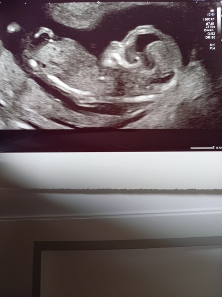 Confused about Nub theory. Girl or boy??