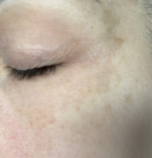 To be worried about skin discolouration, photo included