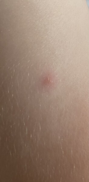Chicken Pox question 