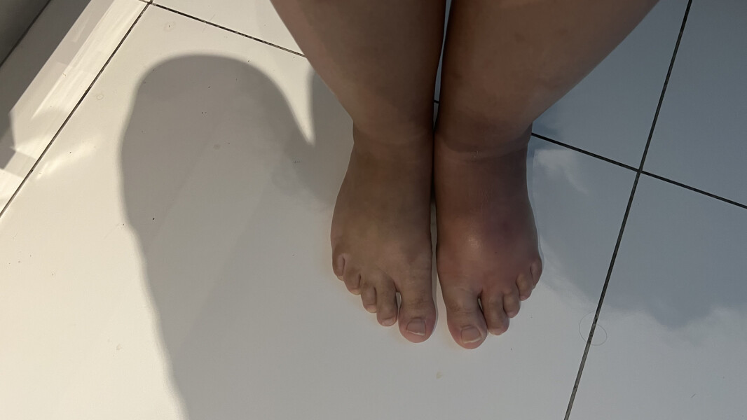 Foot randomly balloooned and swollen, boiling hot