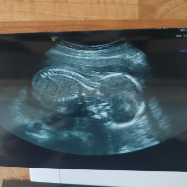 Baby always feet down on scans and kicking low down