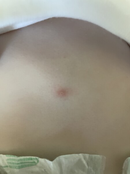 Does my baby have herpes?