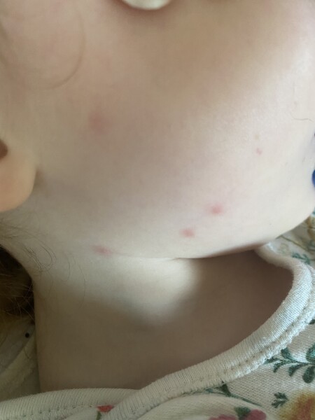 Chicken pox? Flea bites? Bed bugs? Mosquitos?
