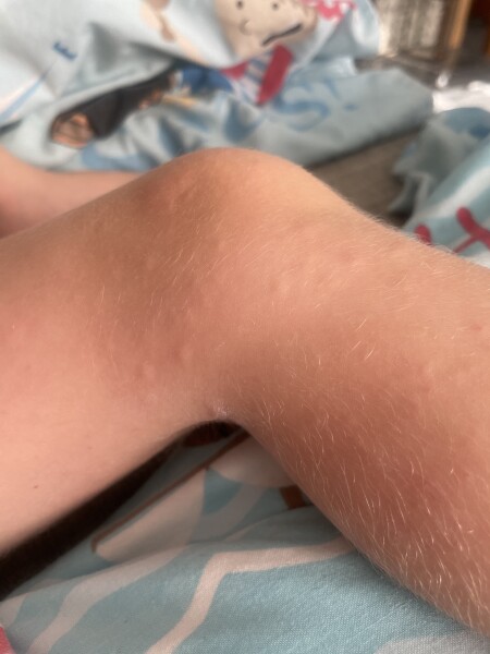 Is this measles or chicken pox or what? 