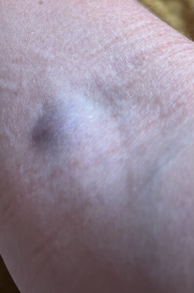 Nurse keeps insisting everytime I have a blood test I keep the cotton wool ball pressed against it with micropore For two hours 