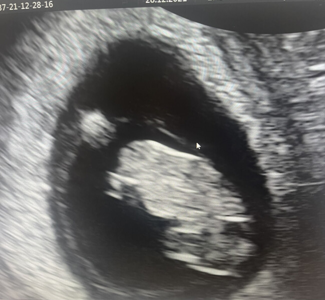 Anyone who has had a scan on or around 8 weeks.