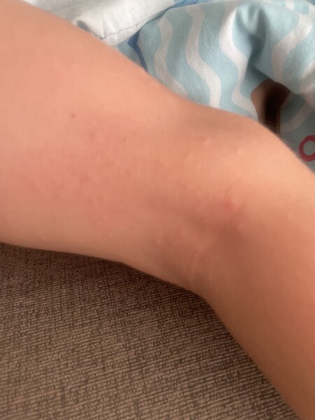 Is this measles or chicken pox or what? 
